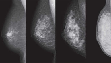 Breast Cancer: वैज्ञानिकों ने स्तन कैंसर के जोखिम वाले चार नये जीन की पहचान की...