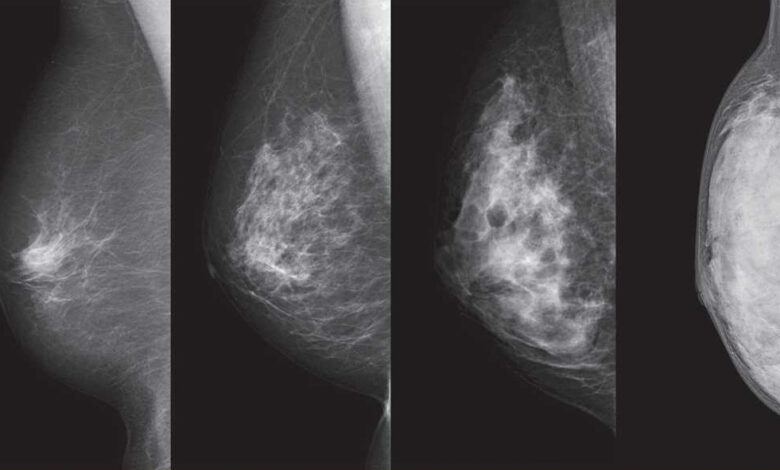 Breast Cancer: वैज्ञानिकों ने स्तन कैंसर के जोखिम वाले चार नये जीन की पहचान की...